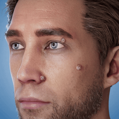 ✨TopSpire® 2-in-1 micronaald- en hydrocolloïdpleisters | Gerichte verzorging voor verheven moedervlekken, acne, platte wratten en steelwratjes | Helpt fijne lijntjes, littekens en huidoneffenheden minder zichtbaar te maken |