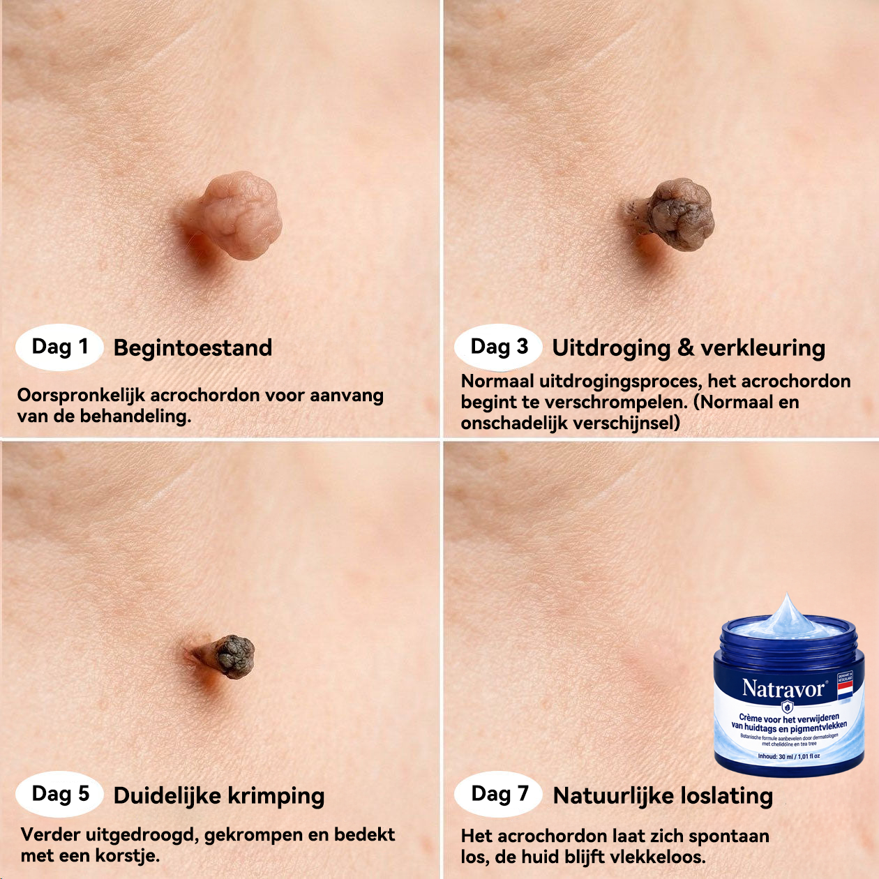 ❤️Natravor® Geavanceerde Corrigerende Crème voor Huidflapjes, Moedervlekken & Vlekken – 7 Dagen Zonder Pijn & Zonder Littekens – Geavanceerde Verzorging voor Huidoneffenheden