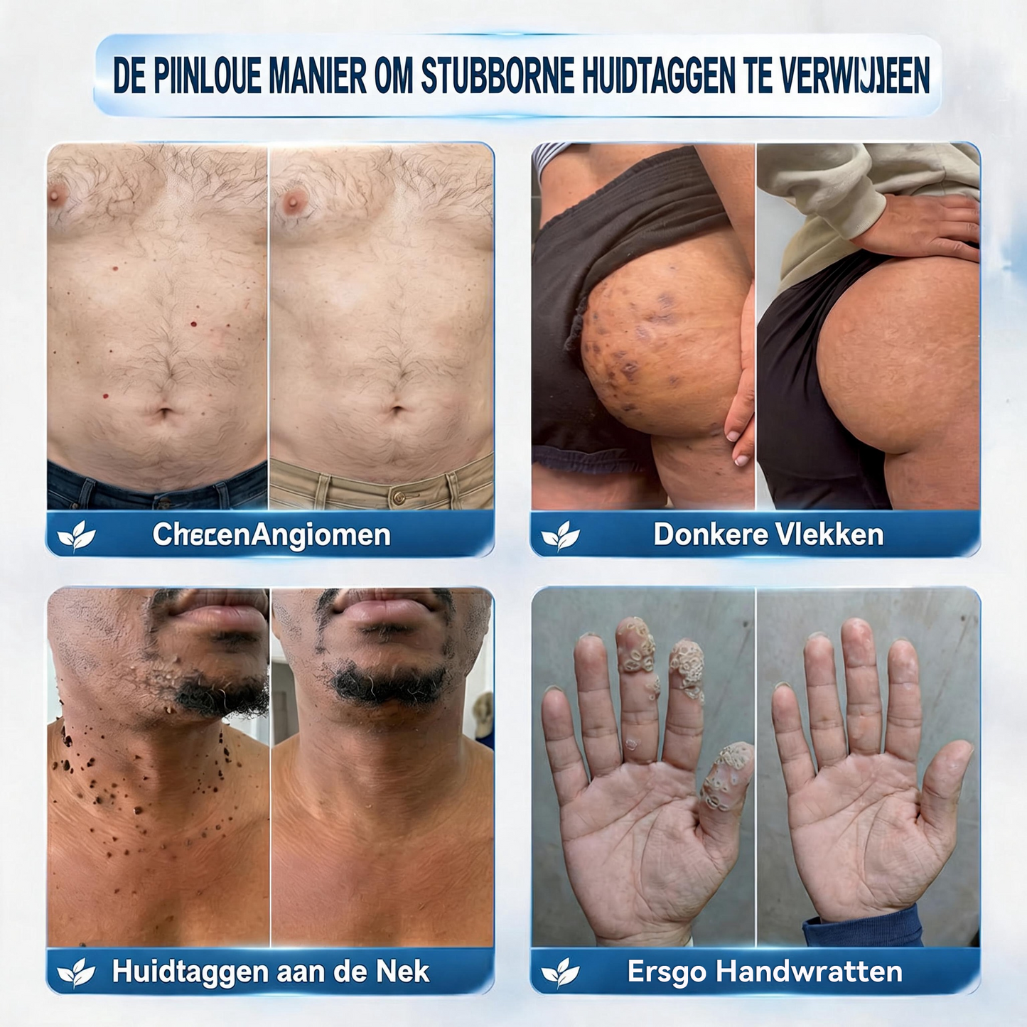 ❤️Natravor® Geavanceerde Corrigerende Crème voor Huidflapjes, Moedervlekken & Vlekken – 7 Dagen Zonder Pijn & Zonder Littekens – Geavanceerde Verzorging voor Huidoneffenheden