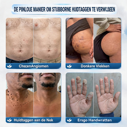 ❤️Natravor® Geavanceerde Corrigerende Crème voor Huidflapjes, Moedervlekken & Vlekken – 7 Dagen Zonder Pijn & Zonder Littekens – Geavanceerde Verzorging voor Huidoneffenheden