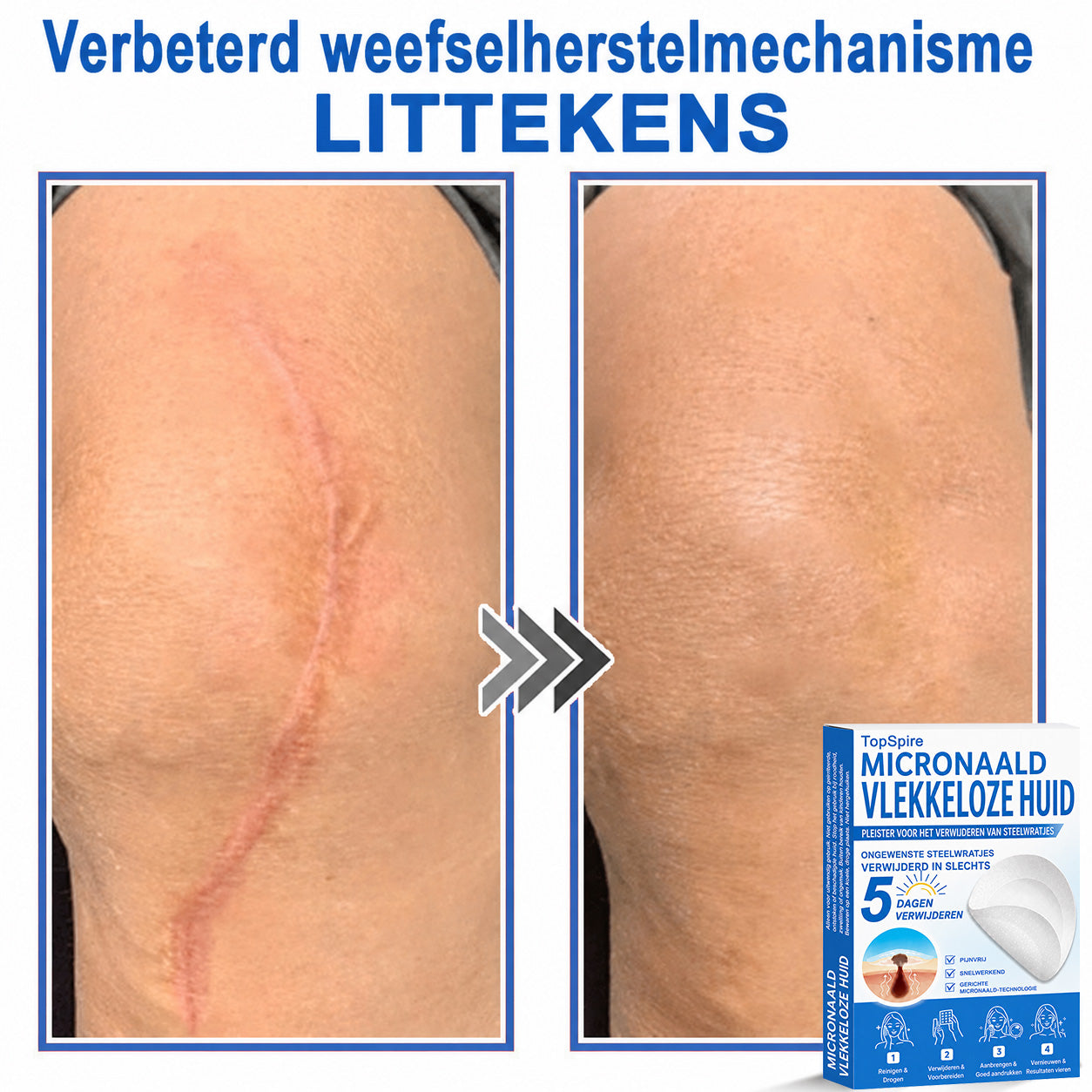 ✨TopSpire® 2-in-1 micronaald- en hydrocolloïdpleisters | Gerichte verzorging voor verheven moedervlekken, acne, platte wratten en steelwratjes | Helpt fijne lijntjes, littekens en huidoneffenheden minder zichtbaar te maken |