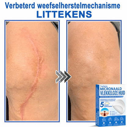 ✨TopSpire® 2-in-1 micronaald- en hydrocolloïdpleisters | Gerichte verzorging voor verheven moedervlekken, acne, platte wratten en steelwratjes | Helpt fijne lijntjes, littekens en huidoneffenheden minder zichtbaar te maken |