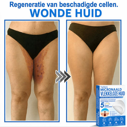 ✨TopSpire® 2-in-1 micronaald- en hydrocolloïdpleisters | Gerichte verzorging voor verheven moedervlekken, acne, platte wratten en steelwratjes | Helpt fijne lijntjes, littekens en huidoneffenheden minder zichtbaar te maken |