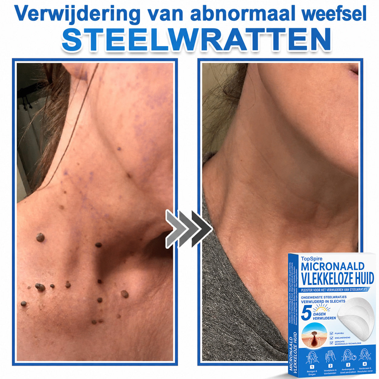 ✨TopSpire® 2-in-1 micronaald- en hydrocolloïdpleisters | Gerichte verzorging voor verheven moedervlekken, acne, platte wratten en steelwratjes | Helpt fijne lijntjes, littekens en huidoneffenheden minder zichtbaar te maken |