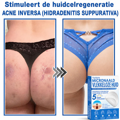 ✨TopSpire® 2-in-1 micronaald- en hydrocolloïdpleisters | Gerichte verzorging voor verheven moedervlekken, acne, platte wratten en steelwratjes | Helpt fijne lijntjes, littekens en huidoneffenheden minder zichtbaar te maken |