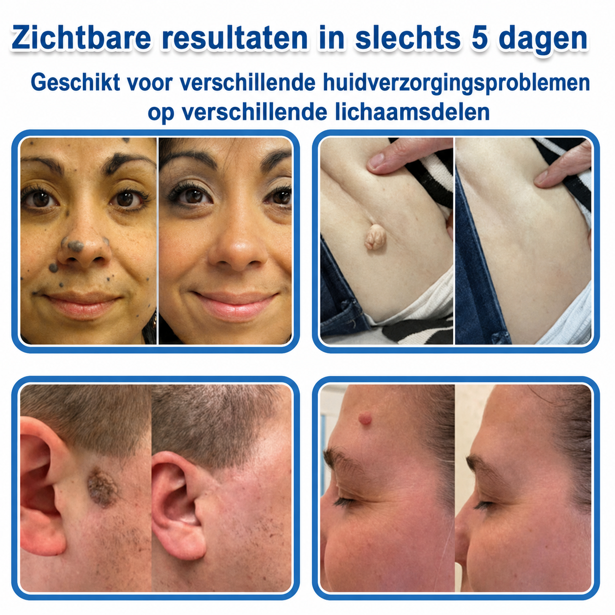 ✨TopSpire® 2-in-1 micronaald- en hydrocolloïdpleisters | Gerichte verzorging voor verheven moedervlekken, acne, platte wratten en steelwratjes | Helpt fijne lijntjes, littekens en huidoneffenheden minder zichtbaar te maken |
