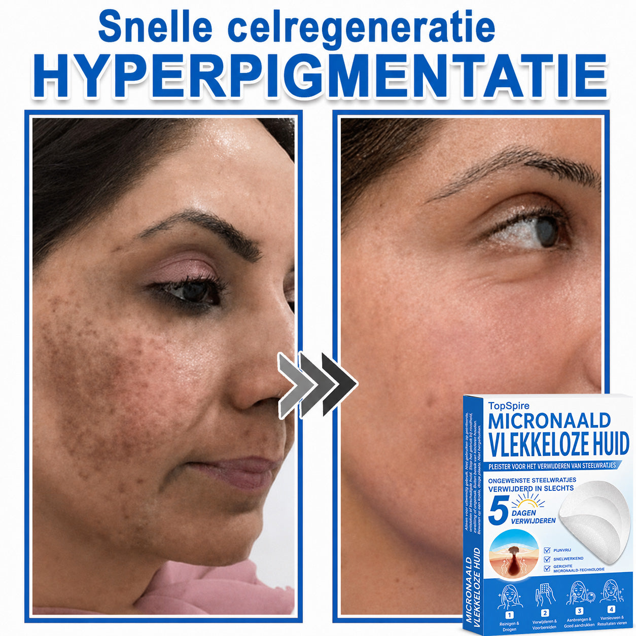 ✨TopSpire® 2-in-1 micronaald- en hydrocolloïdpleisters | Gerichte verzorging voor verheven moedervlekken, acne, platte wratten en steelwratjes | Helpt fijne lijntjes, littekens en huidoneffenheden minder zichtbaar te maken |