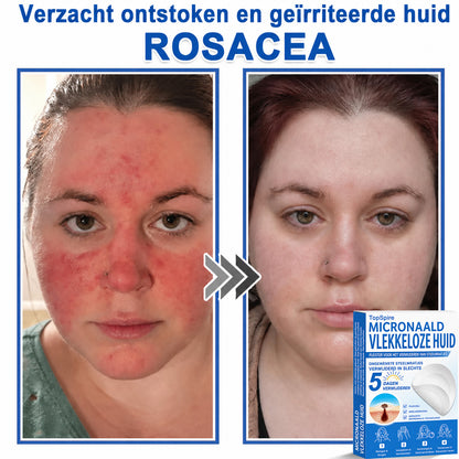 ✨TopSpire® 2-in-1 micronaald- en hydrocolloïdpleisters | Gerichte verzorging voor verheven moedervlekken, acne, platte wratten en steelwratjes | Helpt fijne lijntjes, littekens en huidoneffenheden minder zichtbaar te maken |