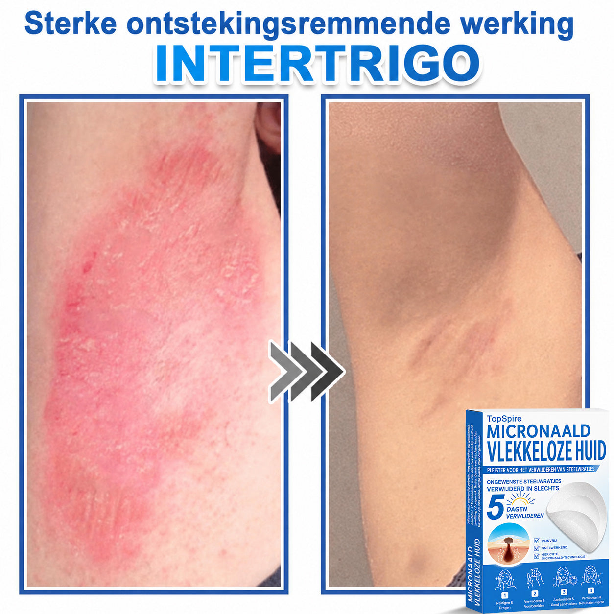 ✨TopSpire® 2-in-1 micronaald- en hydrocolloïdpleisters | Gerichte verzorging voor verheven moedervlekken, acne, platte wratten en steelwratjes | Helpt fijne lijntjes, littekens en huidoneffenheden minder zichtbaar te maken |