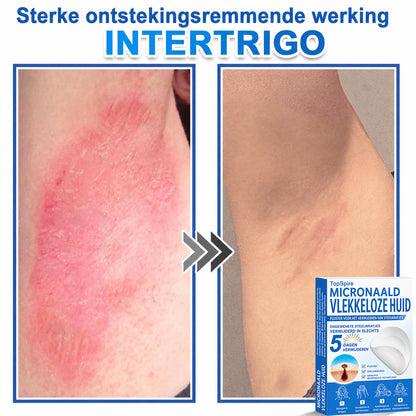 ✨TopSpire® 2-in-1 micronaald- en hydrocolloïdpleisters | Gerichte verzorging voor verheven moedervlekken, acne, platte wratten en steelwratjes | Helpt fijne lijntjes, littekens en huidoneffenheden minder zichtbaar te maken |
