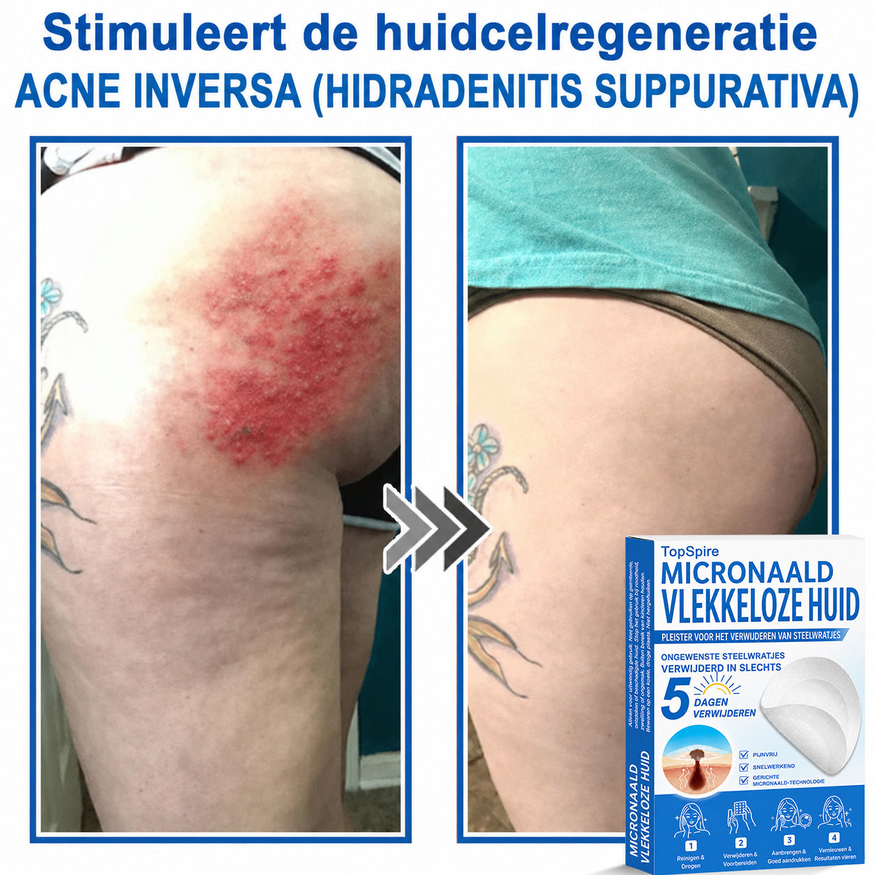✨TopSpire® 2-in-1 micronaald- en hydrocolloïdpleisters | Gerichte verzorging voor verheven moedervlekken, acne, platte wratten en steelwratjes | Helpt fijne lijntjes, littekens en huidoneffenheden minder zichtbaar te maken |