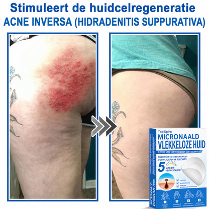 ✨TopSpire® 2-in-1 micronaald- en hydrocolloïdpleisters | Gerichte verzorging voor verheven moedervlekken, acne, platte wratten en steelwratjes | Helpt fijne lijntjes, littekens en huidoneffenheden minder zichtbaar te maken |