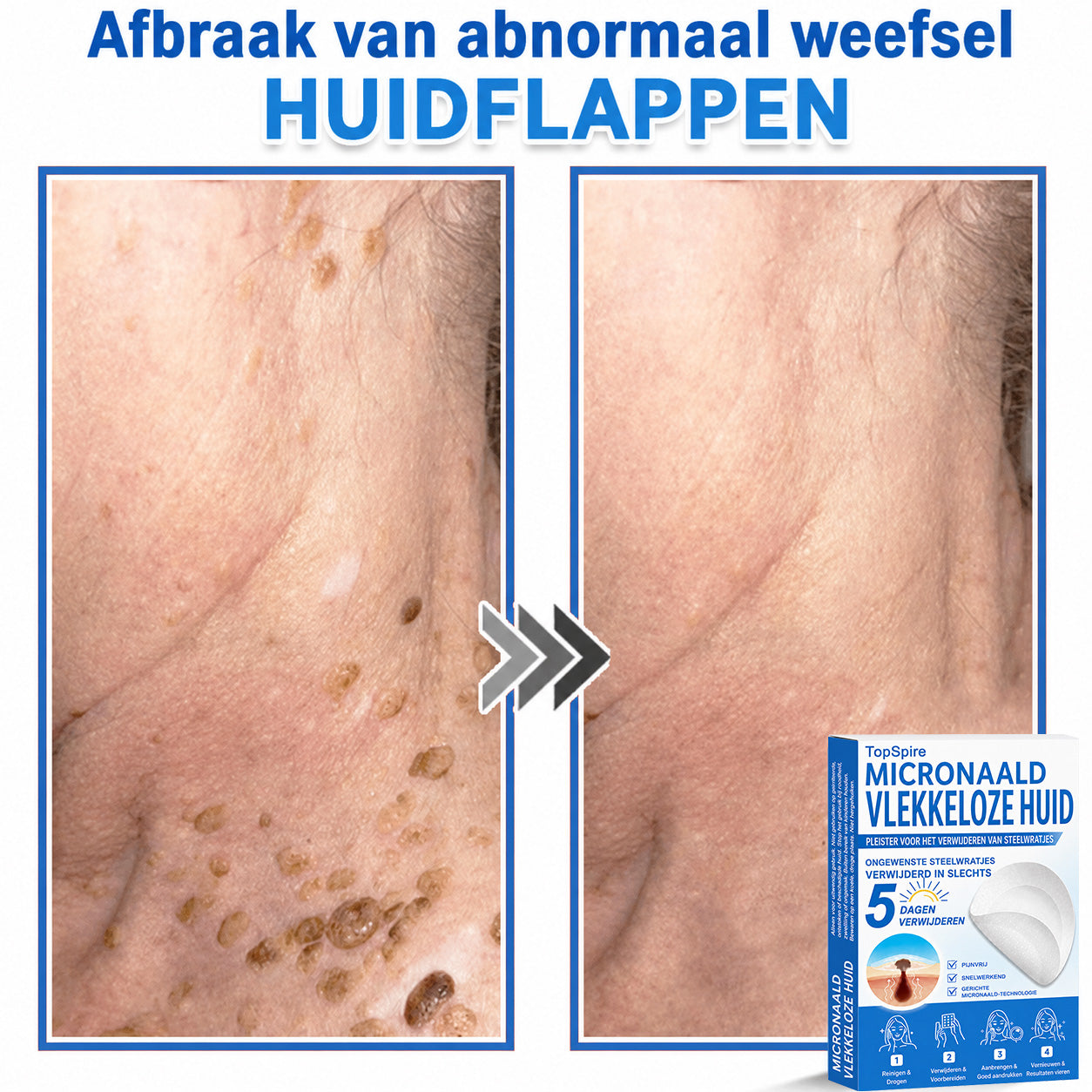✨TopSpire® 2-in-1 micronaald- en hydrocolloïdpleisters | Gerichte verzorging voor verheven moedervlekken, acne, platte wratten en steelwratjes | Helpt fijne lijntjes, littekens en huidoneffenheden minder zichtbaar te maken |
