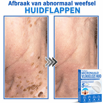 ✨TopSpire® 2-in-1 micronaald- en hydrocolloïdpleisters | Gerichte verzorging voor verheven moedervlekken, acne, platte wratten en steelwratjes | Helpt fijne lijntjes, littekens en huidoneffenheden minder zichtbaar te maken |