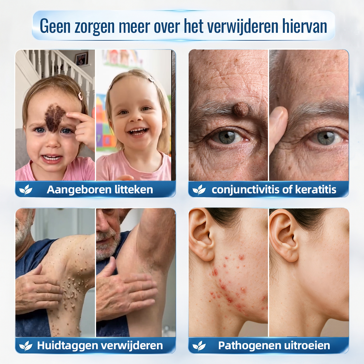 ❤️Natravor® Geavanceerde Corrigerende Crème voor Huidflapjes, Moedervlekken & Vlekken – 7 Dagen Zonder Pijn & Zonder Littekens – Geavanceerde Verzorging voor Huidoneffenheden
