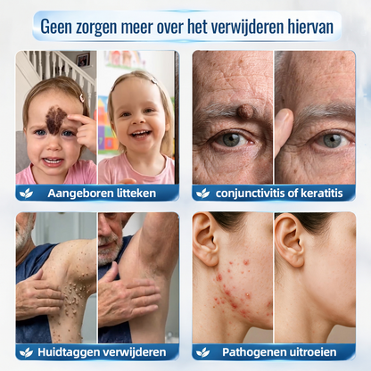 ❤️Natravor® Geavanceerde Corrigerende Crème voor Huidflapjes, Moedervlekken & Vlekken – 7 Dagen Zonder Pijn & Zonder Littekens – Geavanceerde Verzorging voor Huidoneffenheden