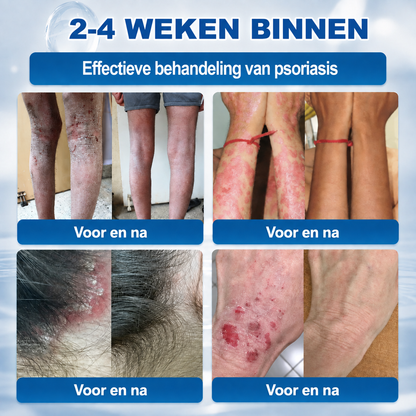 ❤️Natravor® Geavanceerde Corrigerende Crème voor Huidflapjes, Moedervlekken & Vlekken – 7 Dagen Zonder Pijn & Zonder Littekens – Geavanceerde Verzorging voor Huidoneffenheden